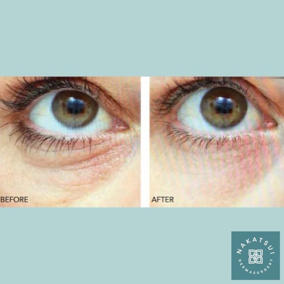 Redensity 1 can improve dull complexion, fine lines, and dehydrated skin by redensifying your skin! Look at these amazing before and afters! 

Is this treatment for you? Give us a call at 780-482-1414 or shoot us a message to book your complimentary consultation to find out! ✨