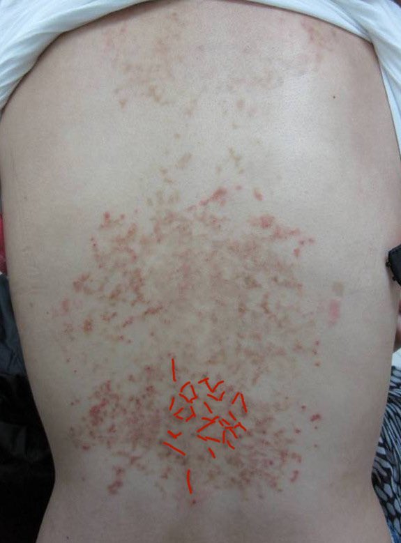 For those that need a bit of help with morphology  If you can appreciate, the erythematous papules are arranged in broken up lines, we call this pattern reticular (or net-like). The ddx for reticular papules/plaques is not that long which helps narrow your ddx!