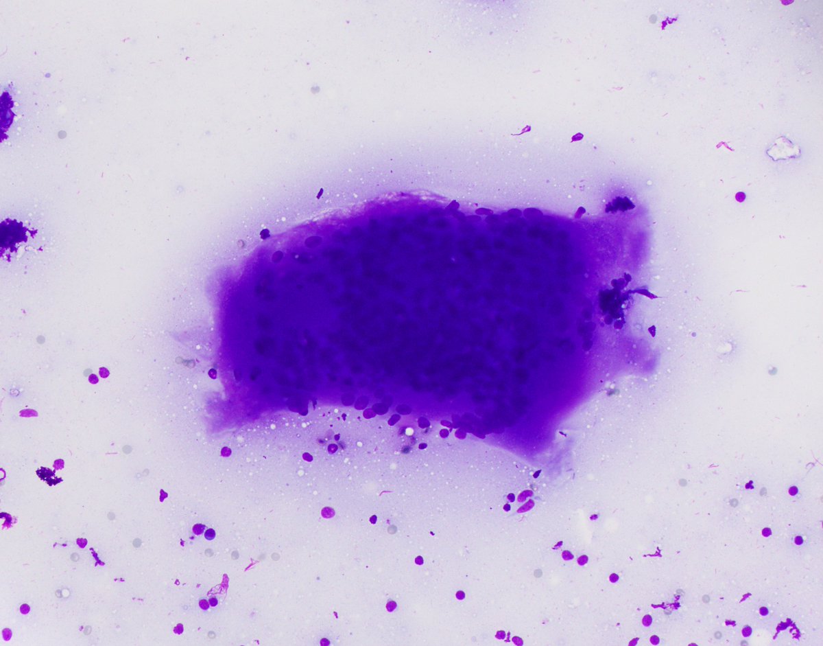 HubertLauMD's tweet image. Living up to their name: Multinucleated giant cells in granulomatous lymphadenitis #FNApath #CytoPath