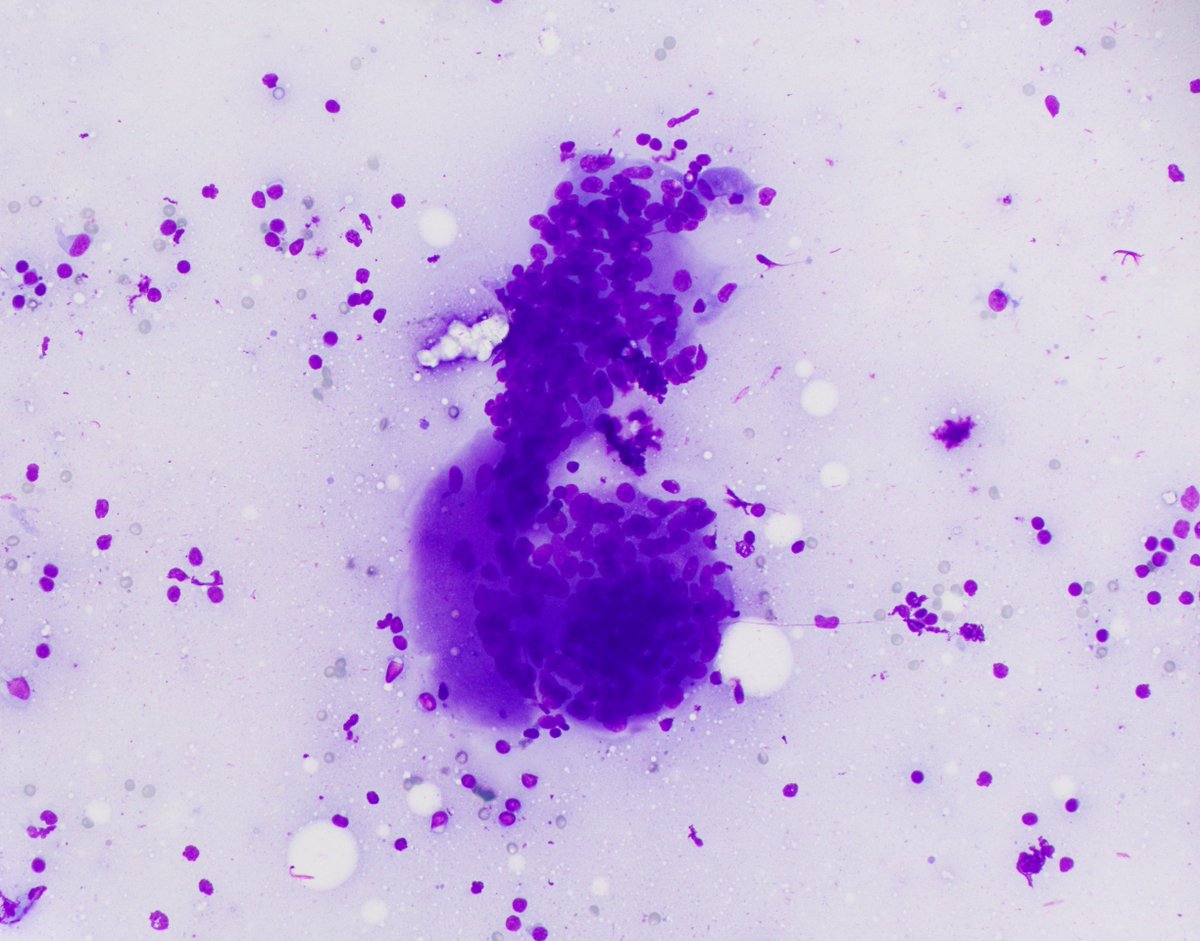 HubertLauMD's tweet image. Living up to their name: Multinucleated giant cells in granulomatous lymphadenitis #FNApath #CytoPath