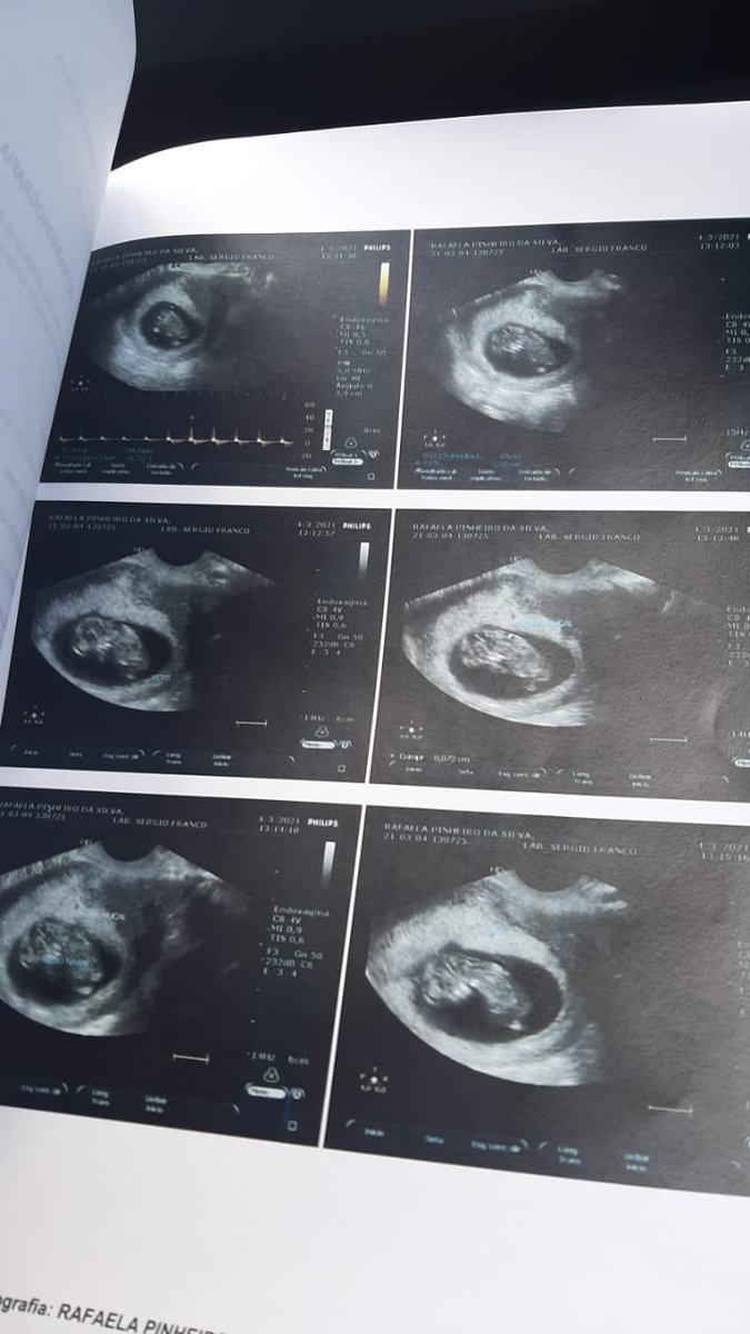 faelaprin's tweet photo. Desde dos 18 anos os médicos disseram q para eu engravidar tinha q fazer vários tratamentos,em janeiro fiz um exame de rotina no ginecologista e não deu nada , em março veio a surpresa, um milagre de 3 meses , Só felicidade meu Deus 🥰🥰🥰 https://t.co/Ki161OfczI