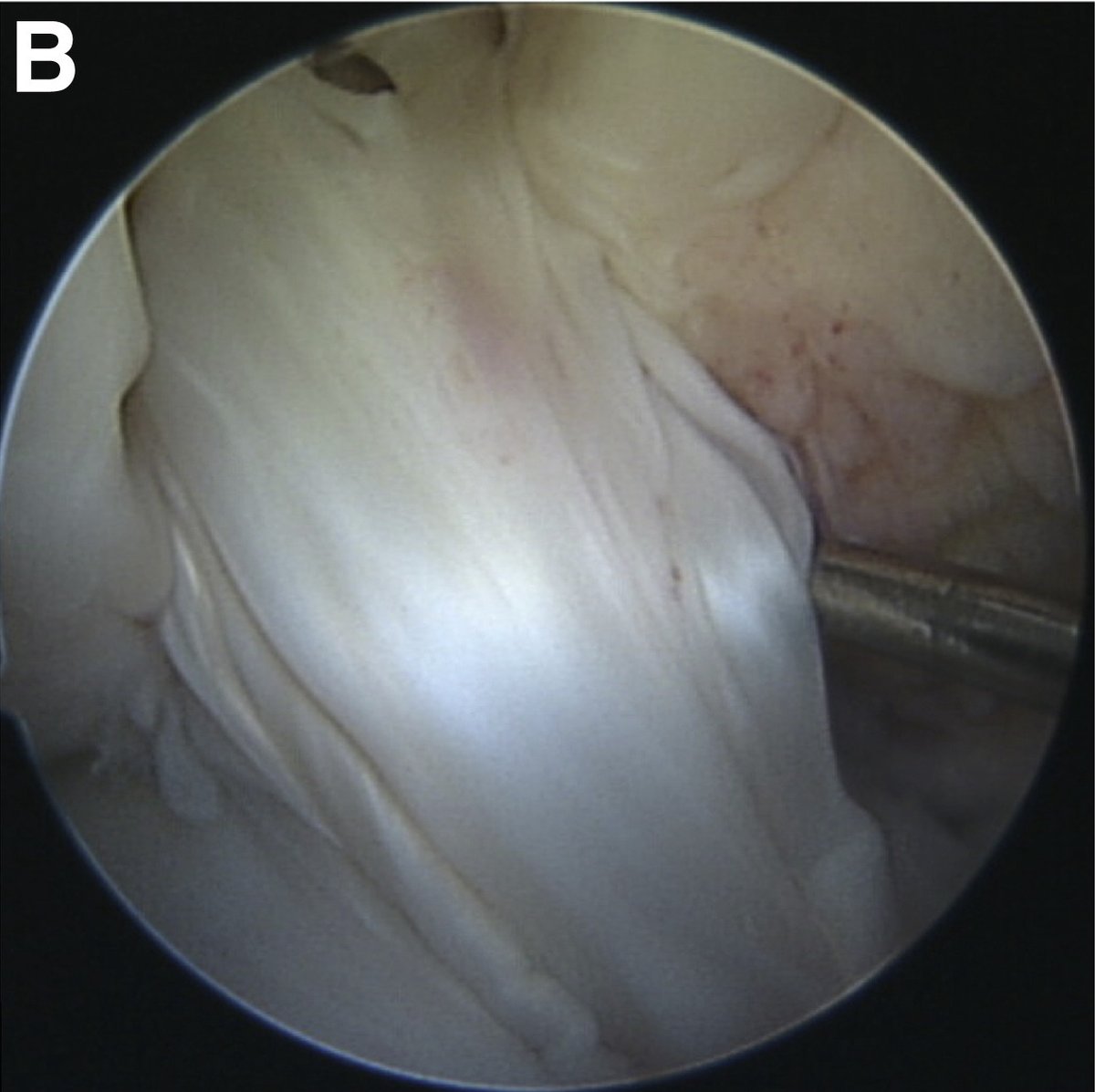 ArthroscopyJ's tweet photo. Bone-quadriceps-tendon has a much wider major and minor complication profile as compared with soft tissue-quadriceps tendon graft for #ACL reconstruction. #knee #arthroscopy @FKSMC_Getgood
https://t.co/6oAhxhZN1k https://t.co/h1WJKR1fA2
