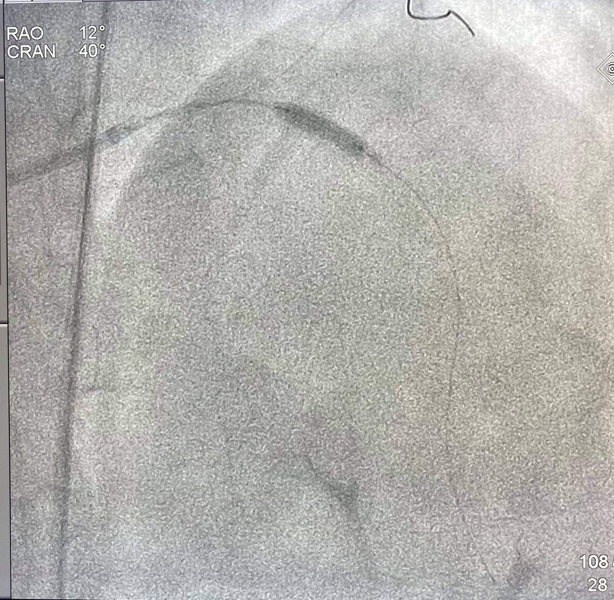 drvijayendran's tweet photo. Shocking our way through...
1st @ShockwaveIVL in Ministry of Health Hospital. Old severely calcifed stent underexpand > #IVL #Shockwave 4atm did the trick expanded 3.5mm size vessel #IVUSguided #Cardiology
#steeplearningcurve 

@KKMPutrajaya
 @DGHisham @DrAdhamBaba https://t.co/IhNRzAKKAs