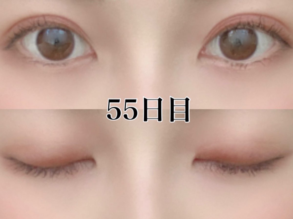 りりこちゃん 埋没経過記録整形垢 Liliy Beauty Twitter