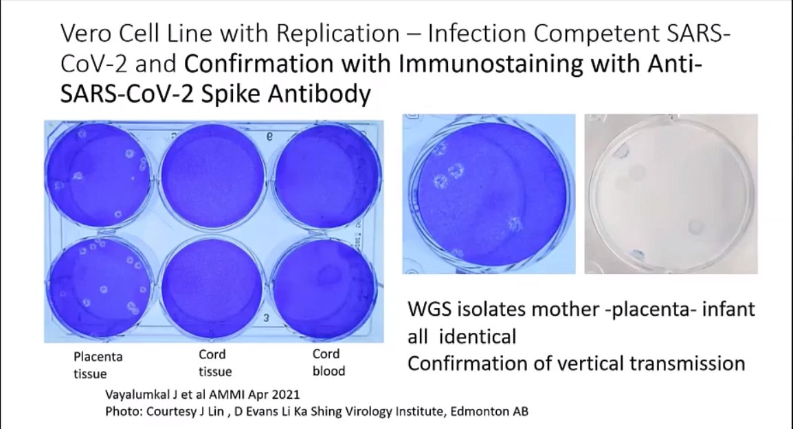 Slide 15 - 41:21 https://www.ammi.ca/Content/2021%20E-poster%20Schedule%20%26%20Presentation%20Instructions.pdf"P23 Congenital SARS-CoV-2 infection in a pre-term neonate with viable virus from the placenta JosephVayalumkal" - Page 4 in the pdf.