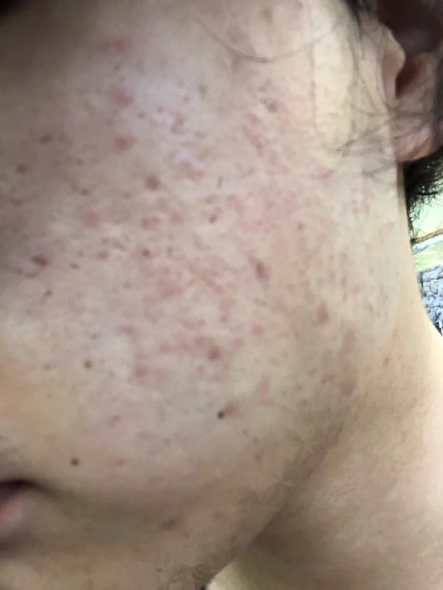 本気で肌トラブルに悩んでる人へ！プロテオリッチを試してみて！