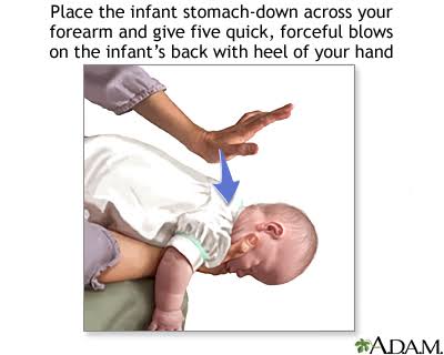 Pada korban bayi (<1 thn), perhatikan teknik dan posisinya.Lakukan prinsip five back blows dan five chest thrust seperti pada korban hamil.Perhatikan gambar ya!