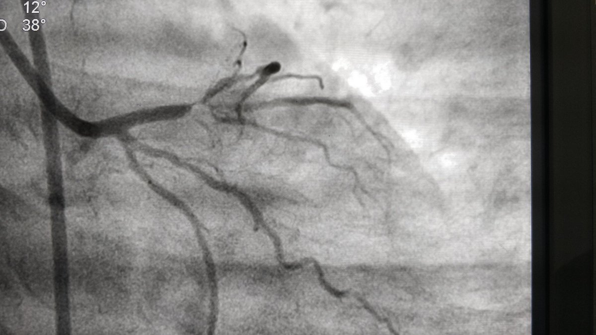 cardio_gotya's tweet photo. 50yr/M, Evolved AWMI, LAD/D1 bifurcation lesion with angle <50°.
Did 'DK nano crush' stenting.
#cardiotwitter #ICtwitter https://t.co/WWtMS2CV54