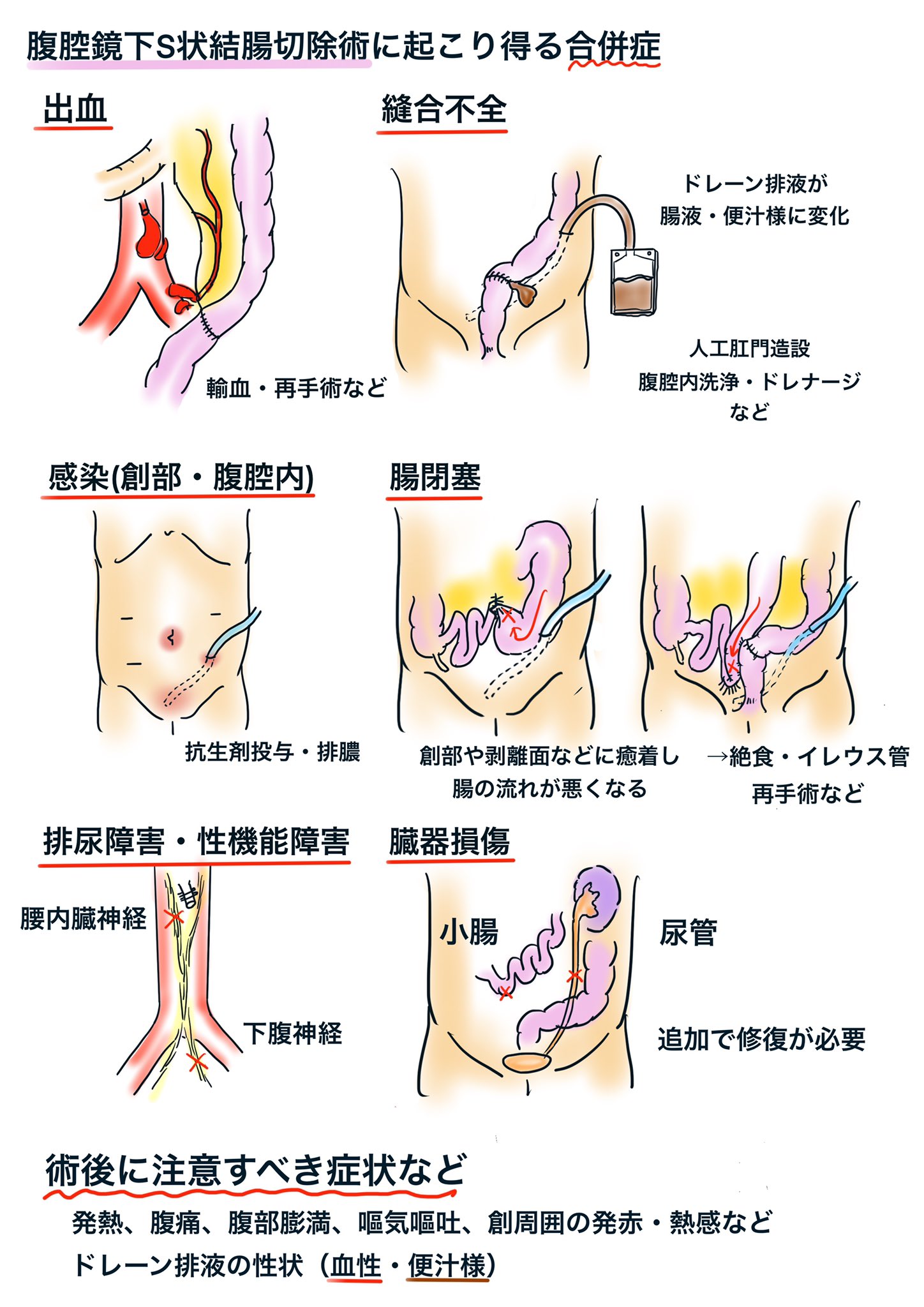 おぺなか 腹腔鏡下s状結腸切除術の合併症 レクチャー用 外科医としてはドレーン排液の色が少しでも濁ってたりモサモサが混じっていたりすると気が気でならないです イラストのような明らかな色ならその場で卒倒します T Co 93ejgof24u Twitter