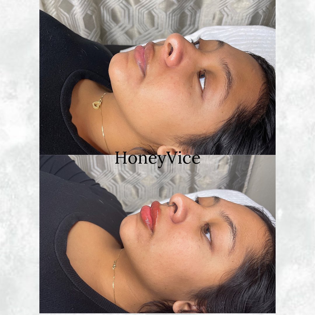 _HoneyVice's tweet photo. 1ml HA Instant natural results ✨

•Needle-less
•100% cross-link Hyaluronic Acid
•instant natural results 
•minimal pain/swelling/bruising 
•Lasts 3-6 months https://t.co/OHNBvsxYx6