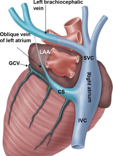 2) The vein of Marshall (VOM), an embryological remnant of the left superior vena cava, runs in the LOM & drains into the coronary sinus
