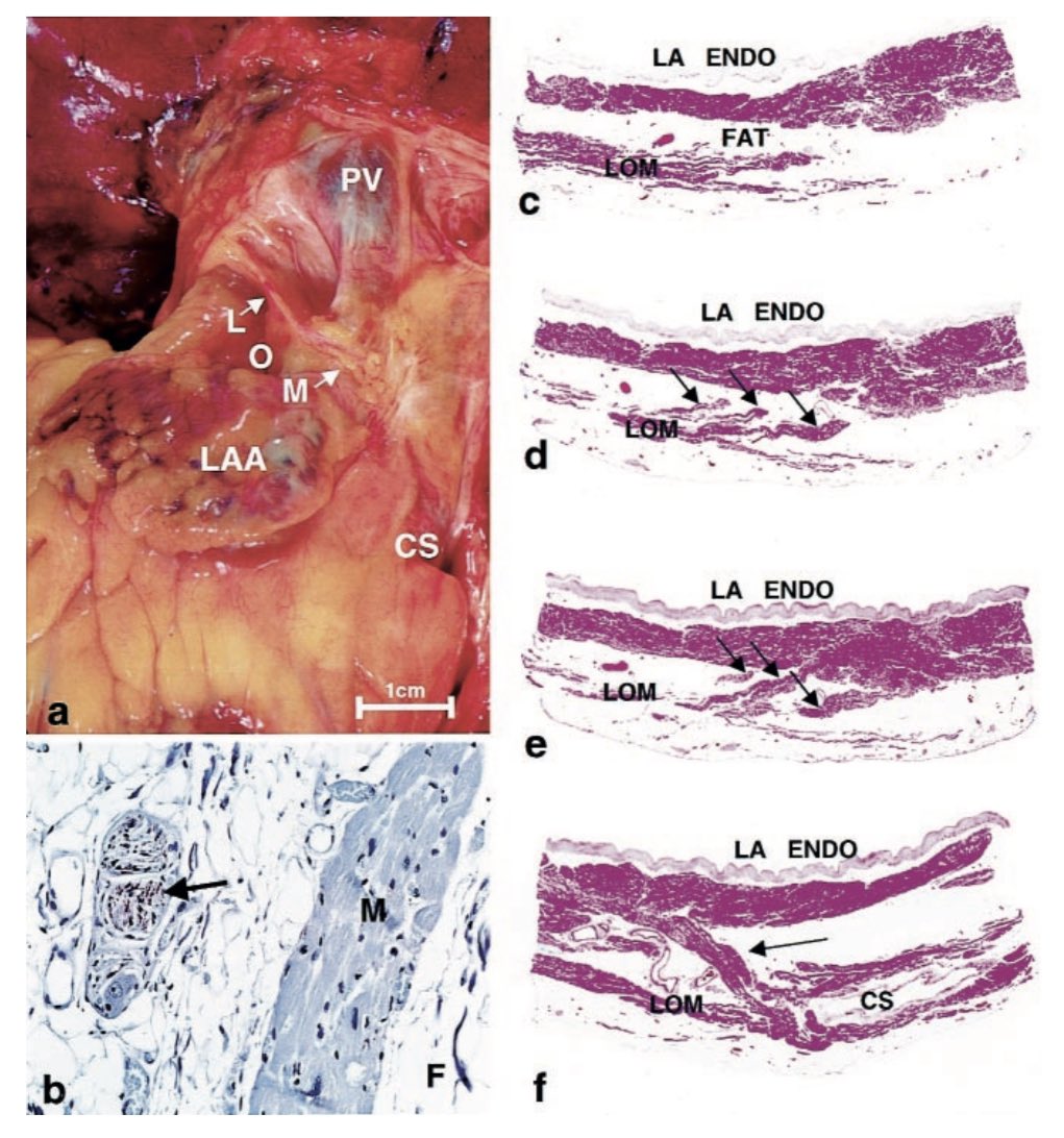 3) An arrhythmogenic role of the VOM has been confirmed in several studies  https://doi.org/10.1016/S0735-1097(00)00819-6