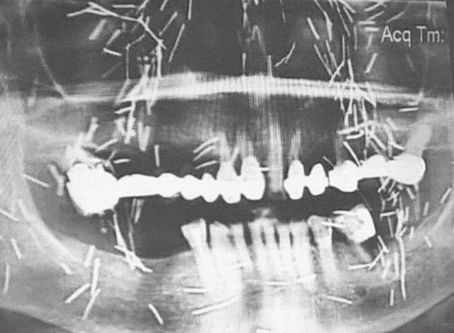 Case ini dishare seorang Radiologist disatu seminar, susuk itu nyata terdeteksi X Ray, awak pernah melakukan operasi berusaha mencari sesuai rontgennya tapi tidak ketemu, tapi mungkin saja sejawat lain berhasil. Gimana sih proses susuk ini?, cuma dibaca gt masuk gt?, Bingung awak