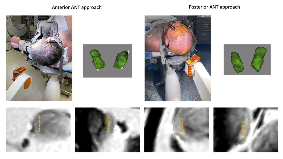 One week, two ANT DBS approaches...best fellowship.