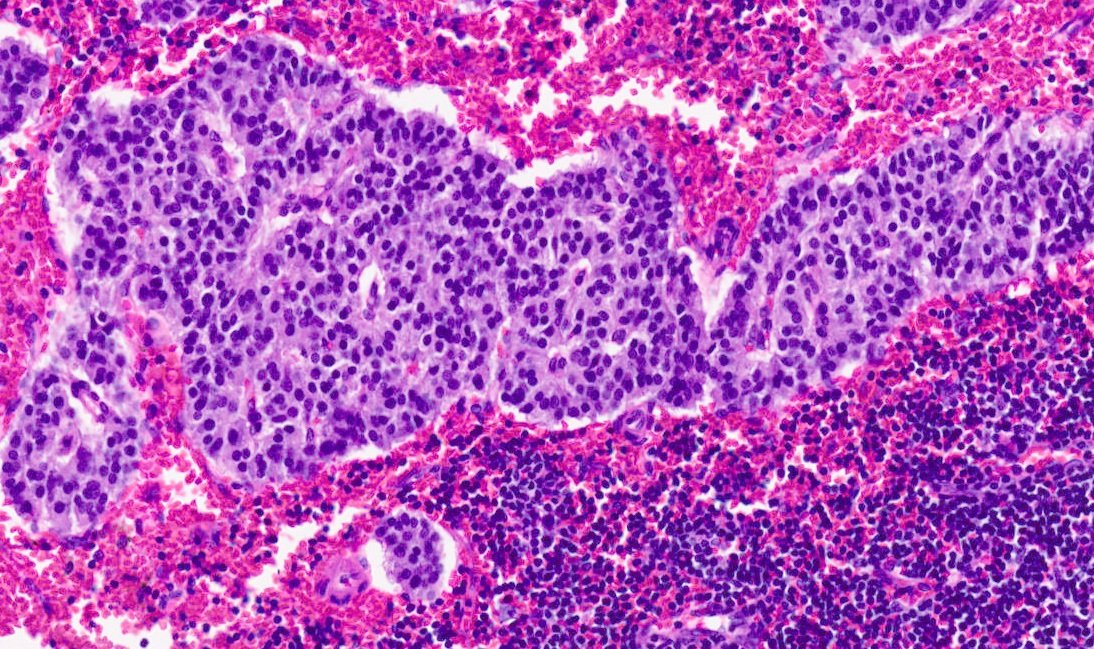 Tumour in a lymph node, GI primary, #pathspotter #GIpath #PathTwitter