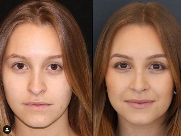 Divulgando2022's tweet photo. Antes e Depois de @Carladiaz e @bilaraujjo
Rosto fake do casal #CarBill Carla Diaz e Bill.
Para ficaram bonitos fizeram cirurgias no rosto e dentes! #BBB21 https://t.co/d3XRtODd3g