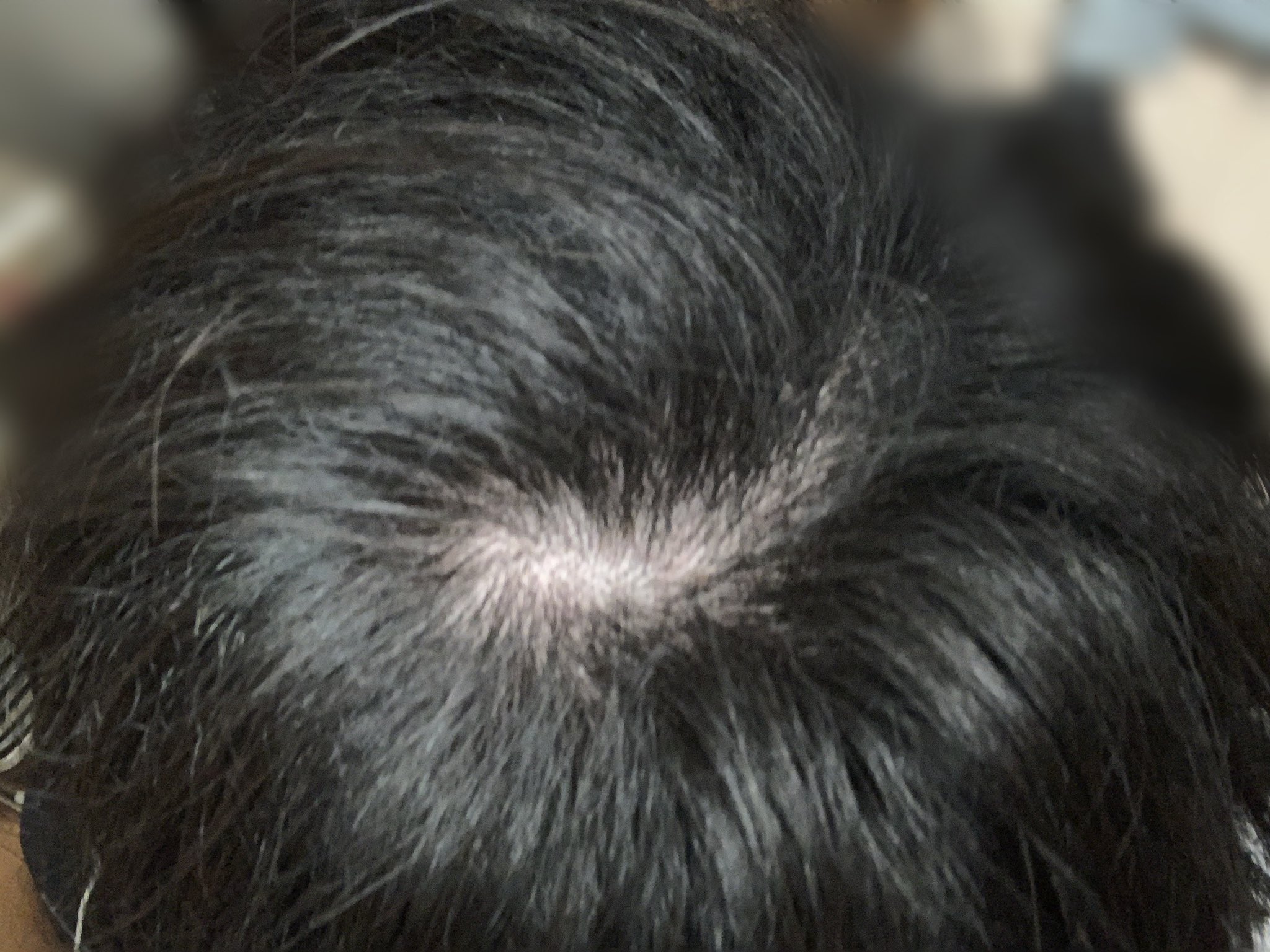 コンプレックスを解消して行こう على تويتر やっぱ頭頂部も昔抜いてて髪が薄いんだよなー つむじ周りが広い あー植毛したい部分がおおい 鬱 笑