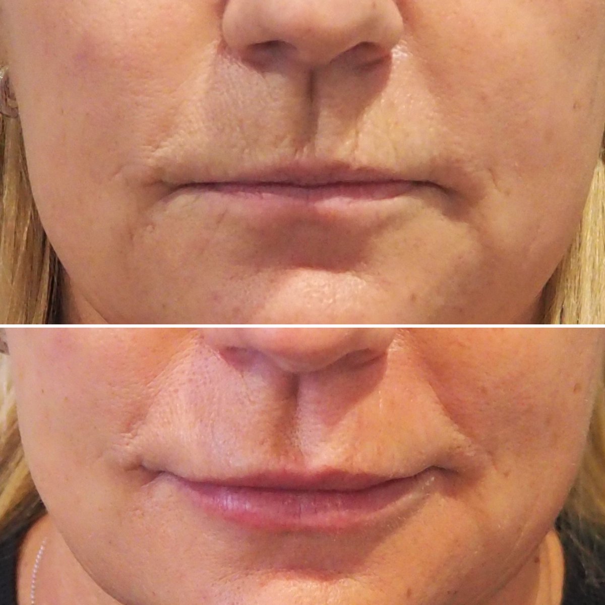 20% off Belotero Balance and Juvederm Ultra fillers - mailchi.mp/5aee7530add4/2…