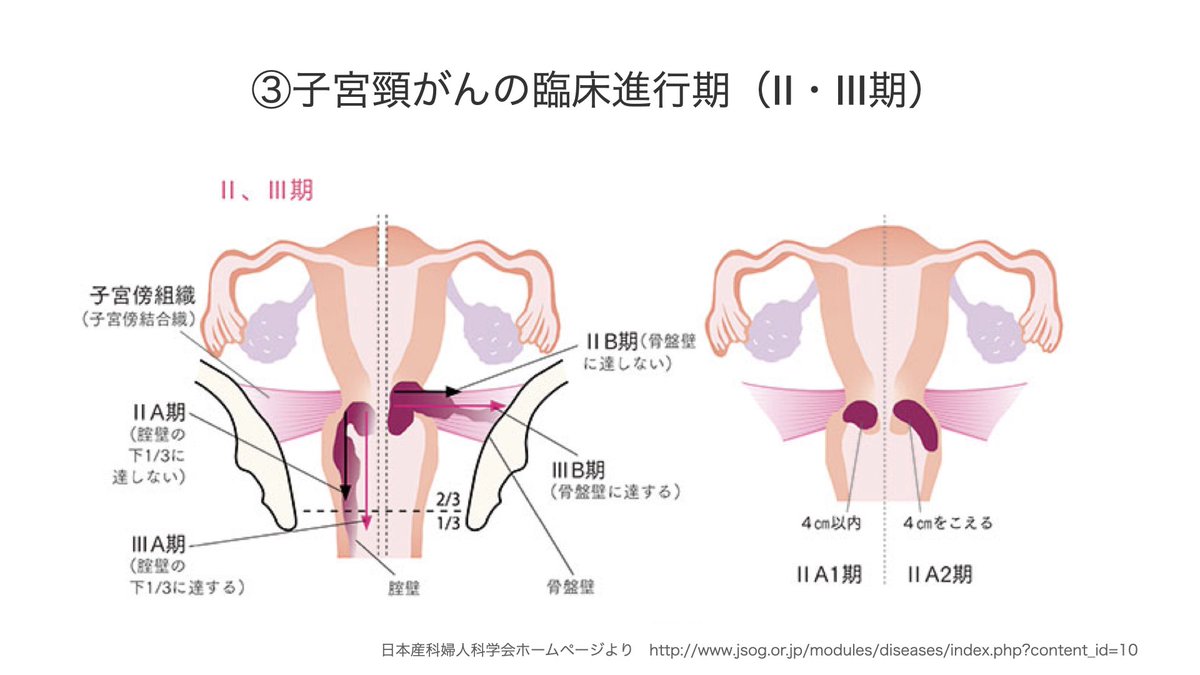 takashi_m86's tweet photo. 4/17 12:30よりClubhouse『🌹男性も知って🙋🏻‍♂️🙋🏻‍♂️女性の体👩🏻‍⚕️何でも相談室🙋🏻‍♀️』で子宮頸がん手術について解説します。
日本産科婦人科学会・国立がん研究センターのウェブサイトを参考にしています。 https://t.co/RFHg5wbFSn