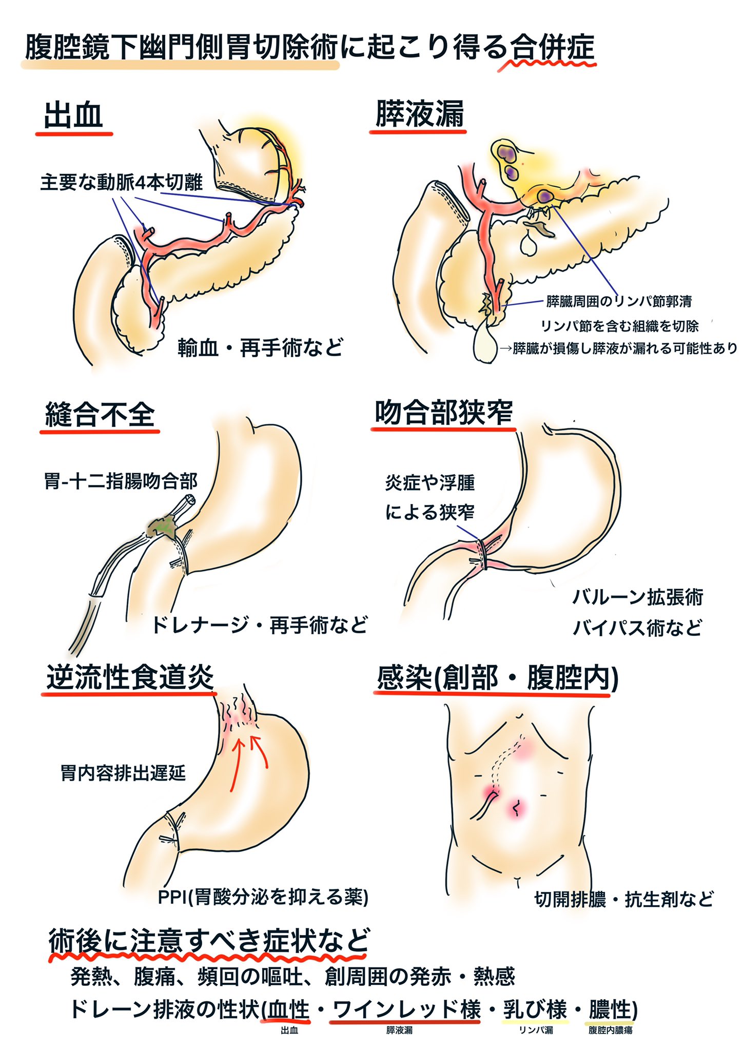 おぺなか 腹腔鏡下幽門側胃切除術の合併症 レクチャー用 胃切除のリンパ節郭清の際には膵臓周囲の操作が必要となります しかし膵臓は柔らかくかつ脂肪と見た目が似ていて扱いが難しい臓器です 胃の手術なのに膵液漏が起こり得るのはこれが理由です