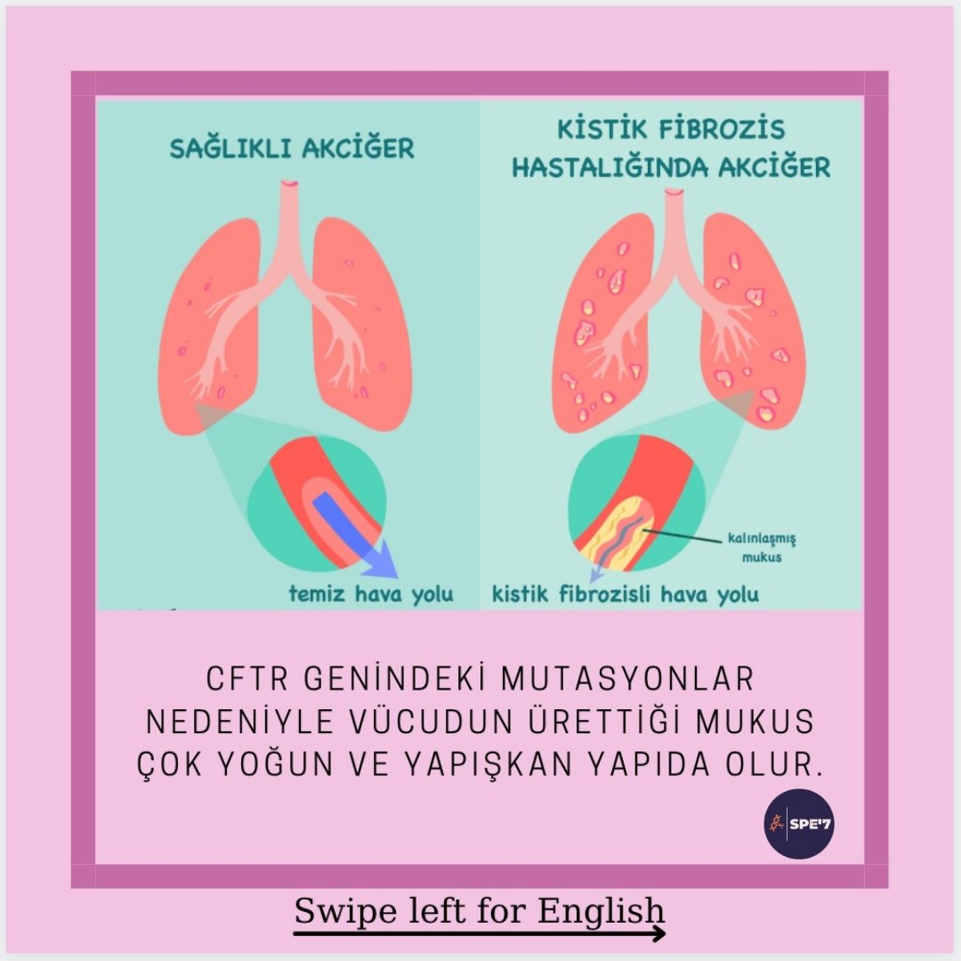 spe7team's tweet photo. Kistik fibrozis hastalığında akciğerlerde nasıl değişim olur ? ⁦@RaDiChallenge⁩ ⁦@CihanTastan_PhD⁩ #cysticfibrosis #kistikfibrozis #raredisease #nadirhastalık https://t.co/o8zj3jGDDM