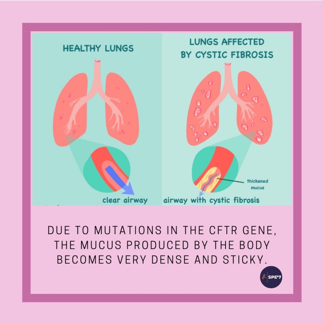 Kistik fibrozis hastalığında akciğerlerde nasıl değişim olur ? ⁦<a href="/RaDiChallenge/">RaDiChal</a>⁩ ⁦<a href="/CihanTastan_PhD/">Cihan Taştan, PhD</a>⁩ #cysticfibrosis #kistikfibrozis #raredisease #nadirhastalık