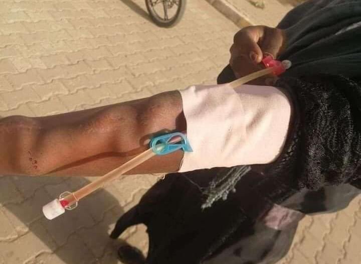 🔴 مرضى الفشل الكلوي في الكاملين، بوصلات غسيل الكلى، طالعين الشارع بحثاً عن مركز او مستوصف فيه كهرباء او وقود لتشغيل جلسات غسيلهم..