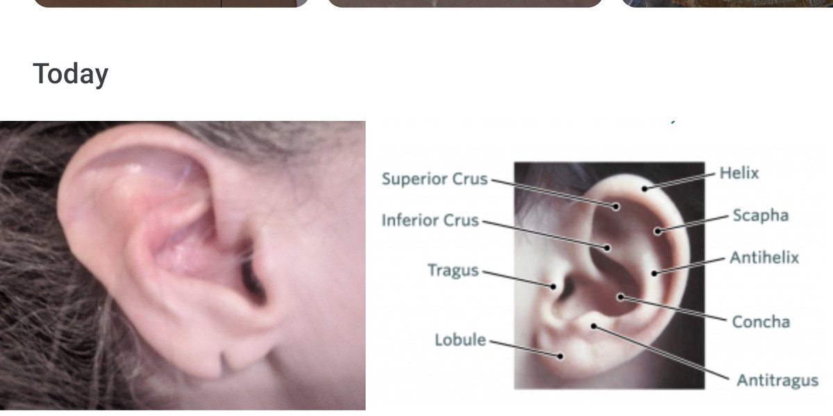 My ear vs a normal ear...
WHAT IM I?? A CHANGELING??!!!!🤣🤣