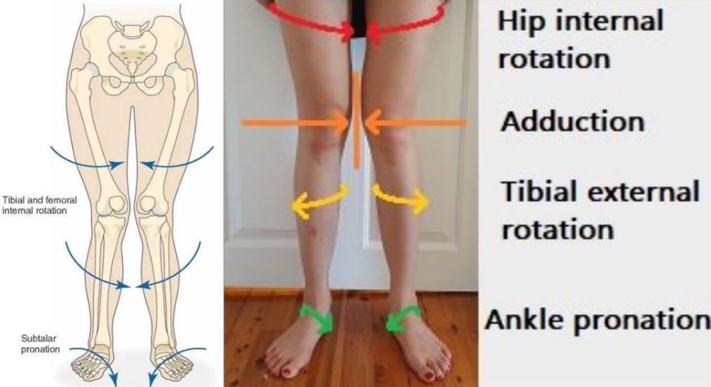 If you see a tibia (lower leg) that's excessively rotated outward, it could be a foot trying to find a pronation strategy and internal rotation due to a leg and/or pelvis that's biased towards external rotation.⁣This can apply to both standing, walking, and running.