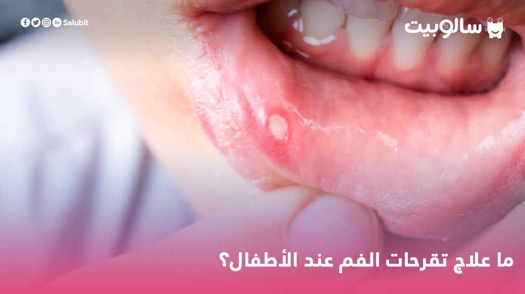 سالوبيت لو طفلك بيعاني من قرح الفم ومش عارفة تتعاملي معاها إزاي تابعي المقال وهتلاقي الإجابة هنا