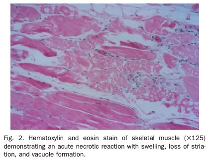 3/Subsequent case descriptions found that patients who developed PRIS also had:Severe rhabdomyolysis and diffuse skeletal and cardiac muscular necrosisHypertriglyceridemiaLactic acidosis Multiorgan failureKids seem to be more susceptible.  https://pubmed.ncbi.nlm.nih.gov/10759487/ 