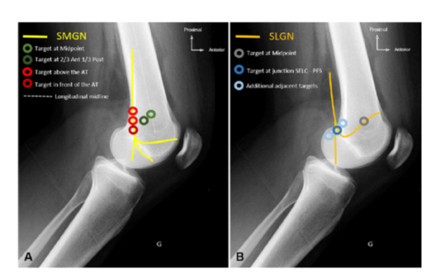 Optimization of Genicular Nerve RFA
Great article with revised targets based on anatomical dissections.
-Targeting the SMGN and SLGN at greater depths to improve results.
rapm.bmj.com/content/45/8/6…
<a href="/TrentDEmerick/">Trent Emerick</a> <a href="/eckmann_max/">Max Eckmann</a>