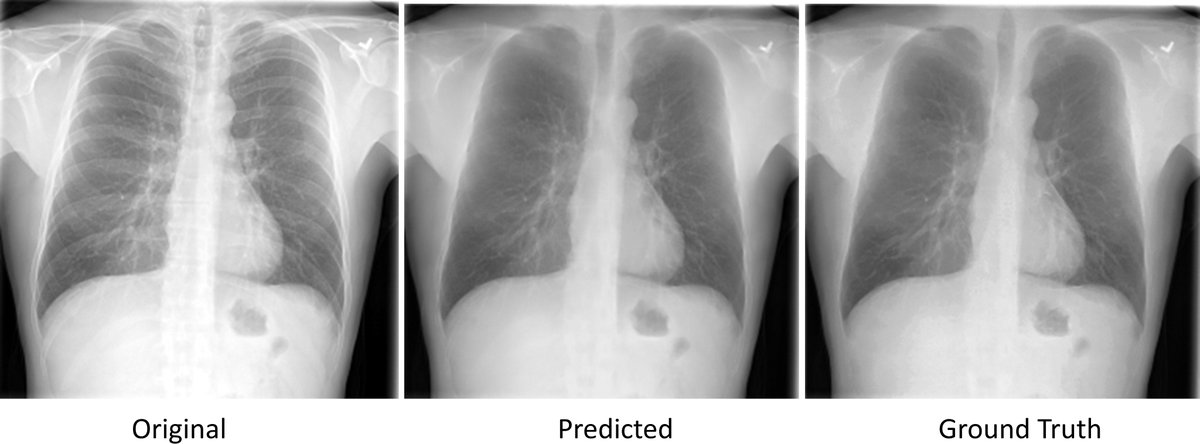 The preprint of our study entitled “Improved TB classification using bone-suppressed chest radiographs” is now available at arxiv.org/ftp/arxiv/pape…. Bone suppression models helped in learning a compact feature space and improve model sensitivity toward TB classification.