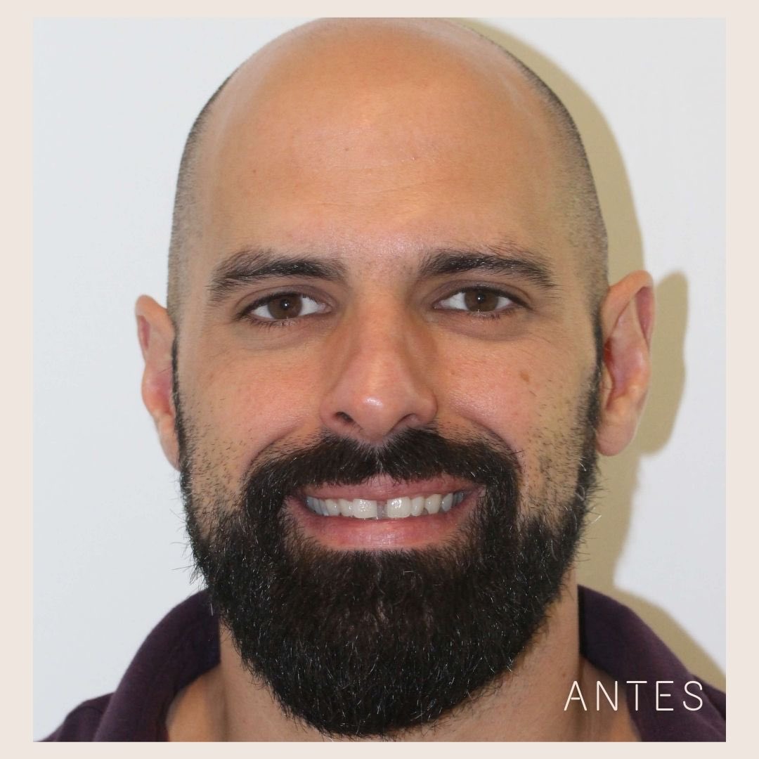 Una sonrisa puede cambiar completamente la imagen de una persona. 

Ejemplo de ello es Pedro José, que ha visto cómo su #sonrisa se transformaba gracias al tratamiento de #carillasdeporcelana. 

Si quieres un cambio radical, ven a Smylife y disfruta de una valoración gratuita.