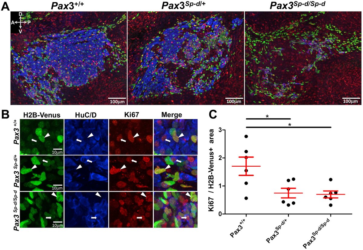 We showed that by mid-gestation in mice with Pax3 mutant spina bifida, the pelvic ganglia that innervate the bladder were severely underdeveloped with significantly reduced area, neural density, and proliferation. 3/