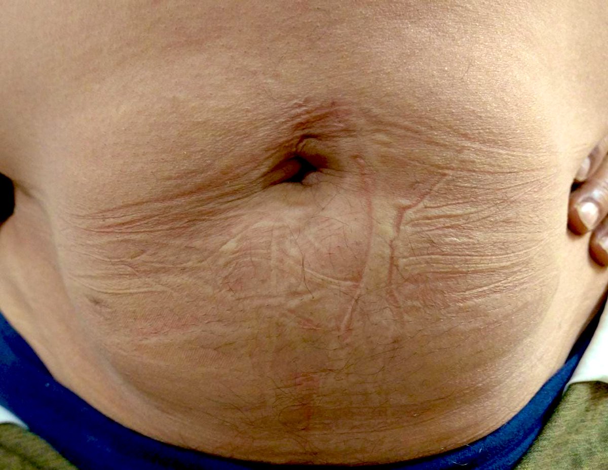 urovictore's tweet photo. Masculino 62 años de edad.
Cáncer de próstata localizado.
Prostatectomía Radical Laparoscópica a 18 meses de vigilancia oncológica.
pT2 N0 M0 (Adenocarcinoma acinar con suma de Gleason 3+4)
APE actual 0.01 ng/ml

#prostatecancer #UroSoMe https://t.co/vef0egGjn1