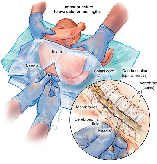 Let's talk about infant LP stylet practices for insertion & removal. As an intern, I memorized these techniques, but didn't understand why.I hope this  #tweetorial helps explain the WHY and improves your procedural acumen!  #PEM  #PEMTwitter1/Img: NEJM
