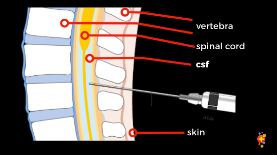 Standard LP needles are "cutting" (dissect soft tissue). A hollow needle without a stylet traps skin cells & pushes them into the subarachnoid space, causing a clogged needle, or in the long term, an epidermoid tumor. Adding a stylet prevents this.3/Img:  @DFTBubbles