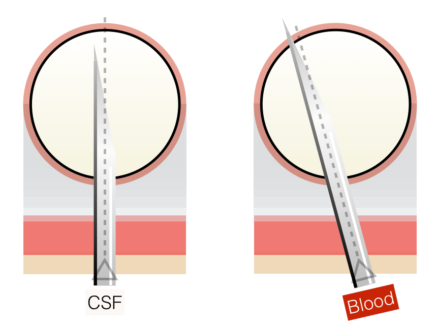 BUT, with a stylet, you can't see CSF return. In infants, it's easy to backwall into the surrounding venous plexus ("traumatic tap"). In early stylet removal (insert needle/stylet through dermis only, then remove stylet), you see CSF as soon as you're in.4/Img:  @PEMTweets