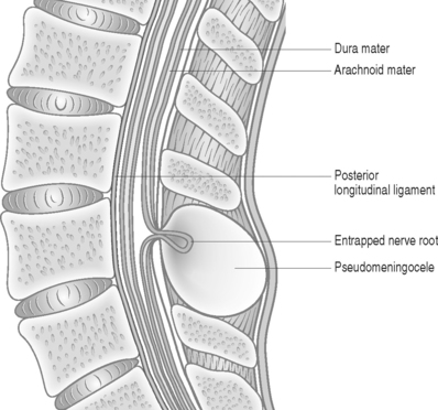 The long term reason is that dragging nerve fibers to outside the subarachnoid space can result in entrapped lumbar/sacral nerves and pseudomeningocele.7/Img: MSK Key