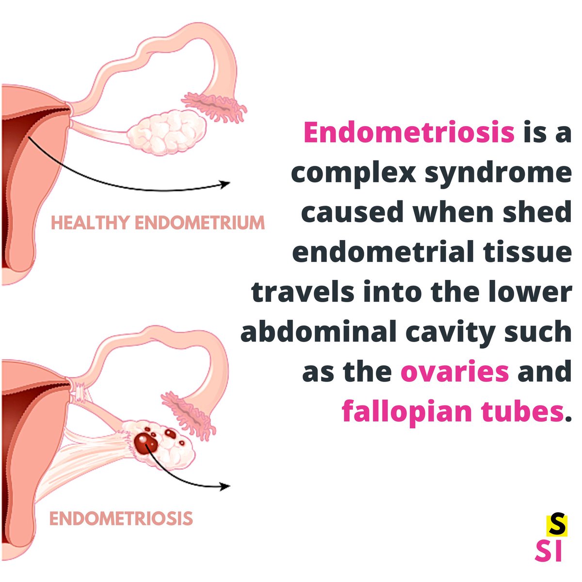 sexinscience's tweet photo. 1/10 people with the female reproductive system in the UK suffer from endometriosis. 10% of people suffer from endometriosis worldwide. It costs the UK economy £8.2 billion a year because of treatment, loss of work and healthcare costs. The main cause of endometriosis is unknown. https://t.co/Vdy1kBZBjc