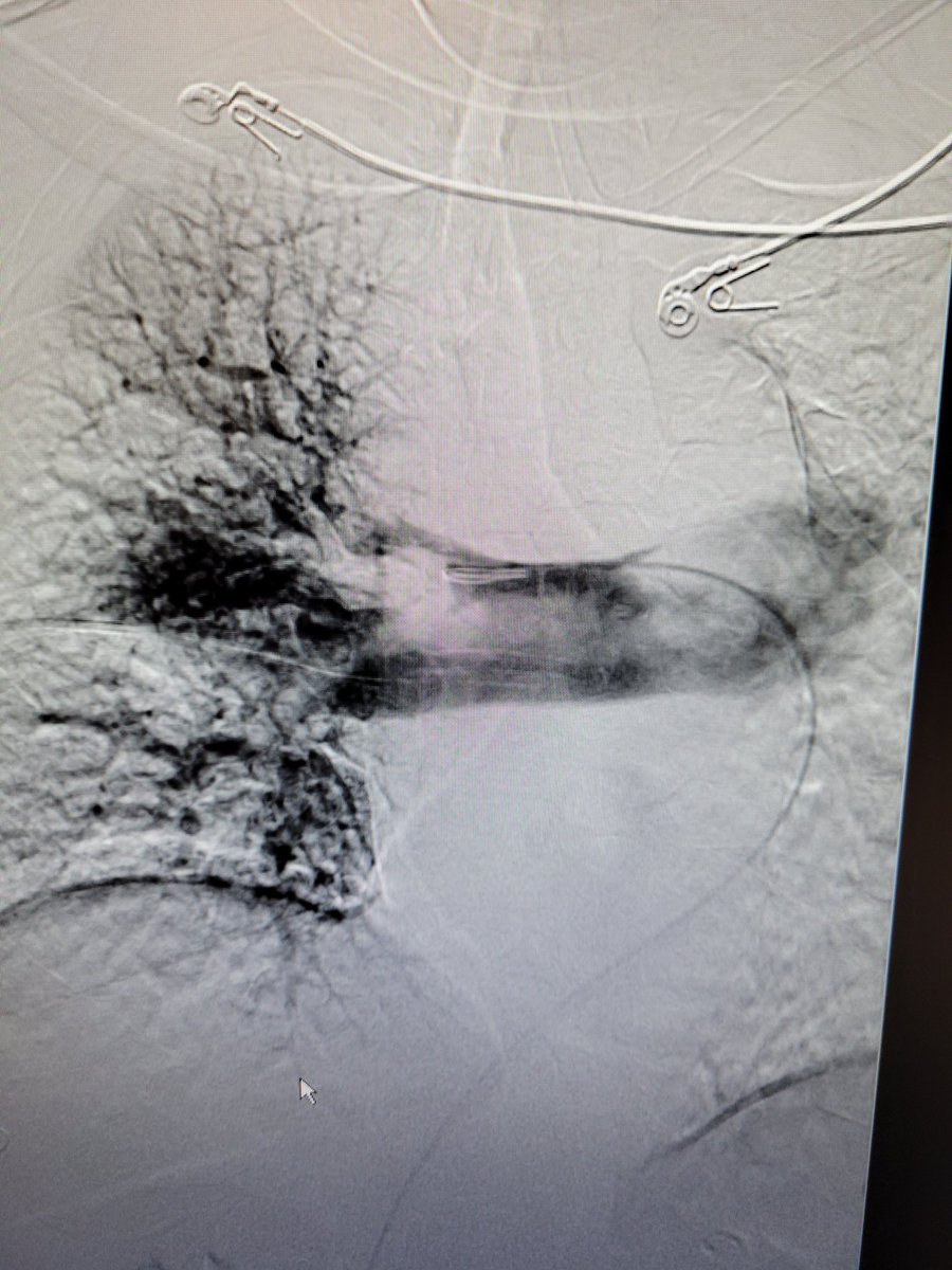 TempleRADs's tweet photo. Patient with submassive saddle PE. Thrombectomy performed with Inari Flowtriever T24 with new T20 Curve on the left. What a haul! Thrombus is no match for our doctors. Impressive work by @AaronLoseyMD @Nmontec2 and Dr. Nameet Patel. @TempleRadRes @SIRRFS @SIR_ECS @InariMedical https://t.co/uZfz4Gk4zv