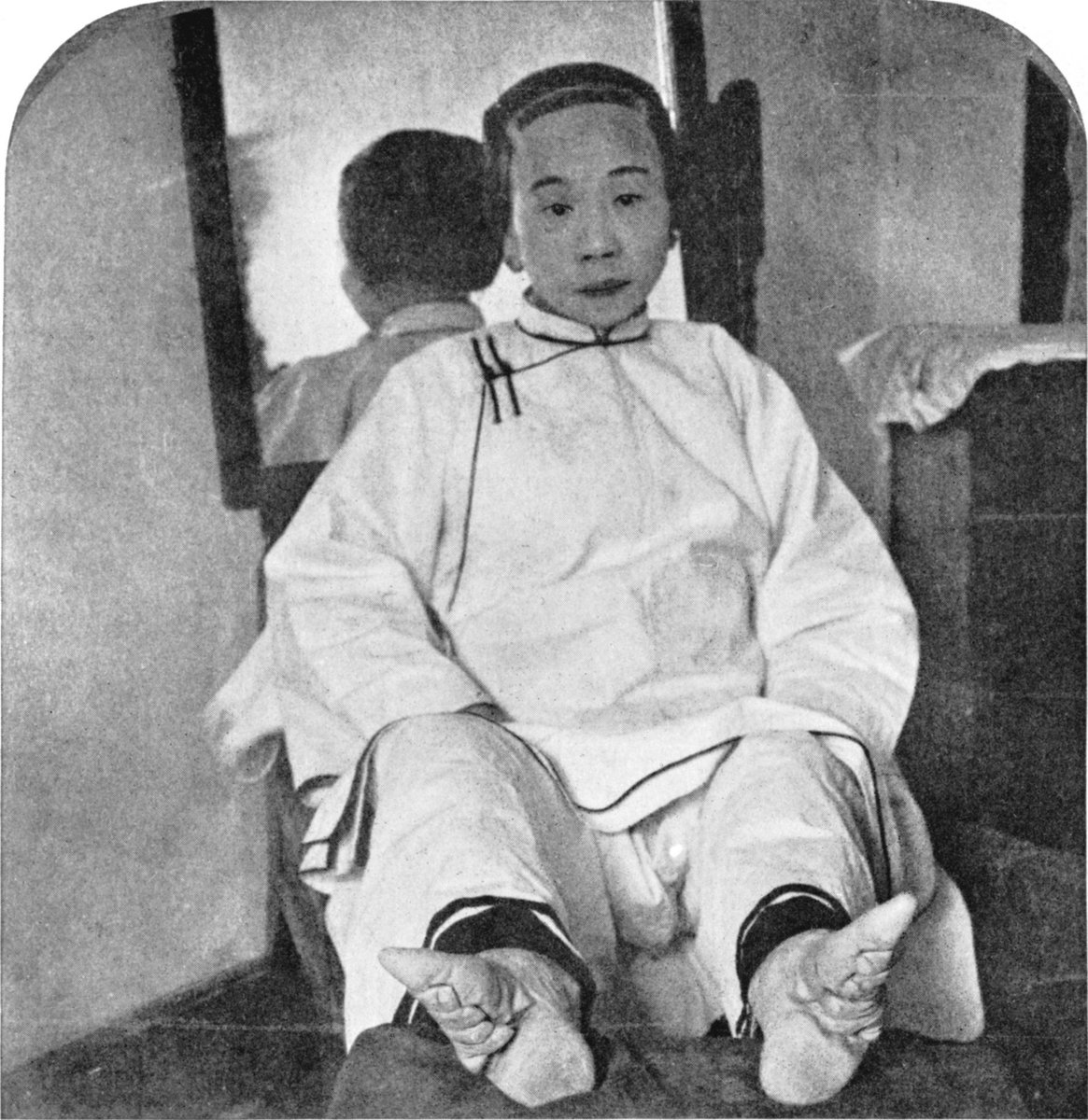 Foot binding was a Chinese tradition in which young girls' feet were broken and tightly bound in order to alter their shape and size.These shoes were used by women in China with bound feet. They were called "lotus shoes".