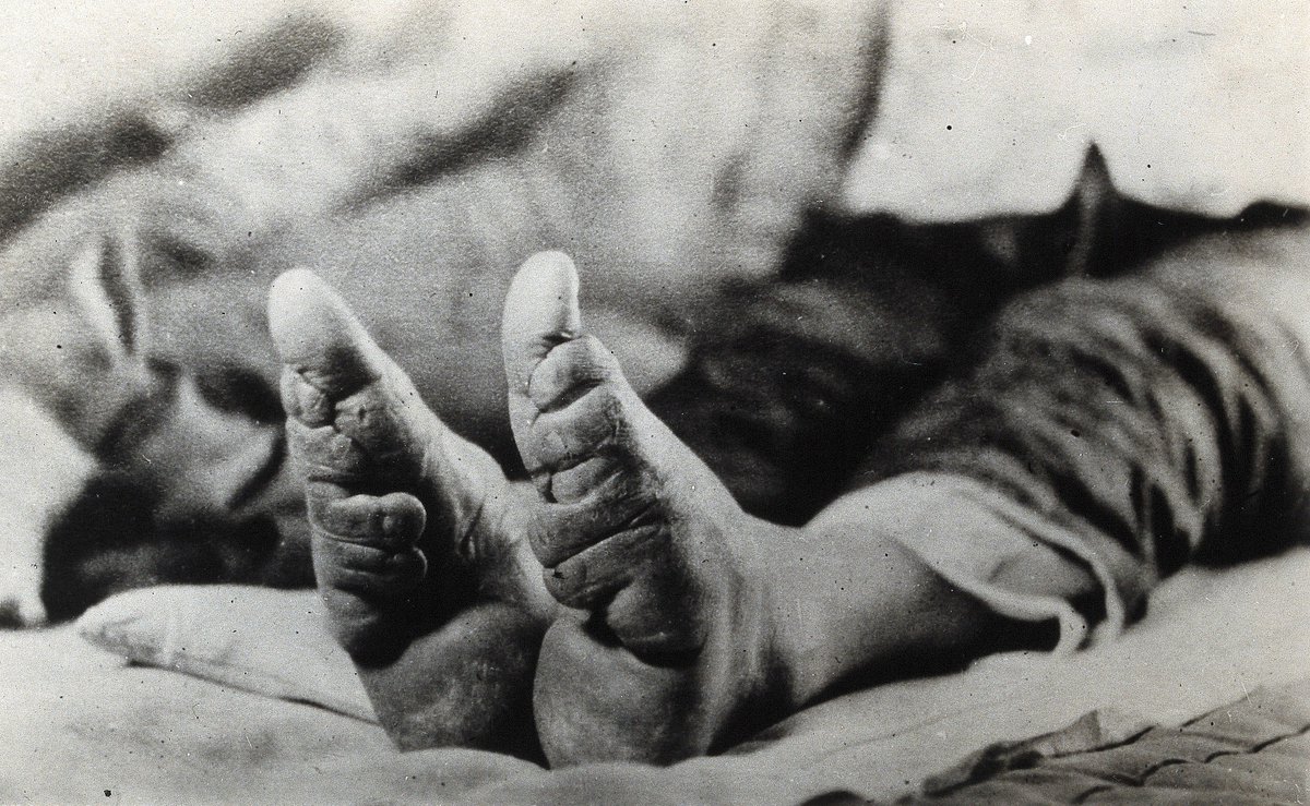 Feet of a Chinese woman, showing the effect of foot-binding.
