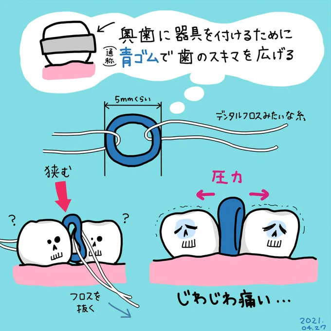 2021年4月27日(火) 矯正歯科で奥歯に青ゴム入れてもらった! 明日にはもう取って奥歯にバンドを付ける予定 連休中は痛くてごはん食べられないかもしれない