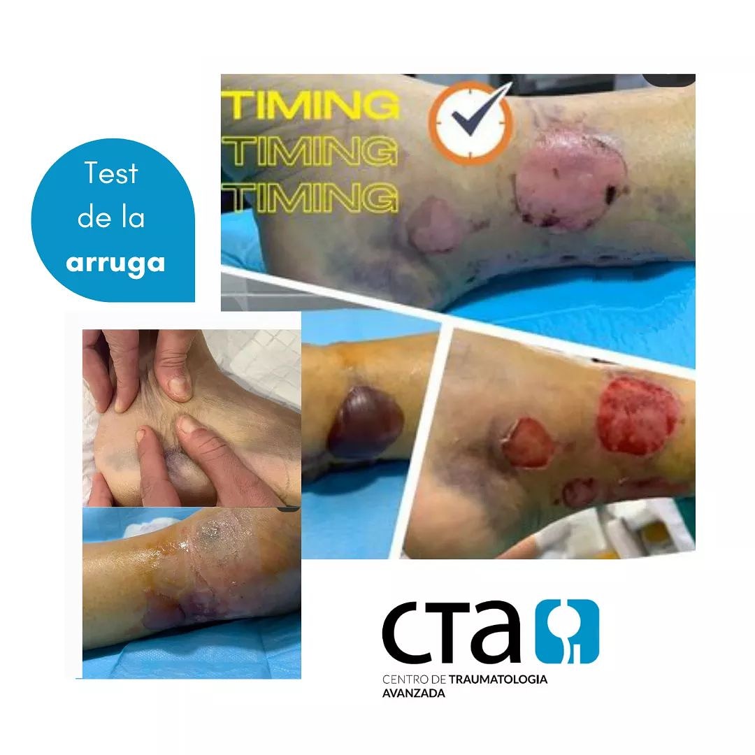 Os recomendamos el post del Dr. García Paños sobre el Test de la arruga. 

Leedlo completo en instagram.com/p/COKf5_-h0w3/…

#centrotraumatologiaavanzada #centrodetraumatologiaavanzada #murcia #traumatologomurcia #traumatologia