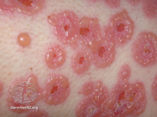 Steven Chen 陳持威, MD, MPH, MHPEd (@drsteventchen) on Twitter photo A new "Rash of the Day!"
The only history I'll give you is this is an adult patient.
Go!
#dermtwitter #medtwitter #RashOTD A new "Rash of the Day!"
The only history I'll give you is this is an adult patient.
Go!
#dermtwitter #medtwitter #RashOTD
