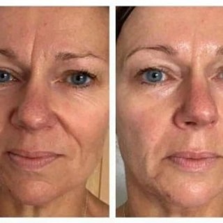 meduffield's tweet image. Friends, if you care about your skin, you have to check out this amazing skin care device!
7 benefits in just 2 minutes!
Works on a whole host of skin issues as well as fine lines and wrinkles and reduces the size of pores!
I highly recommend this device!
