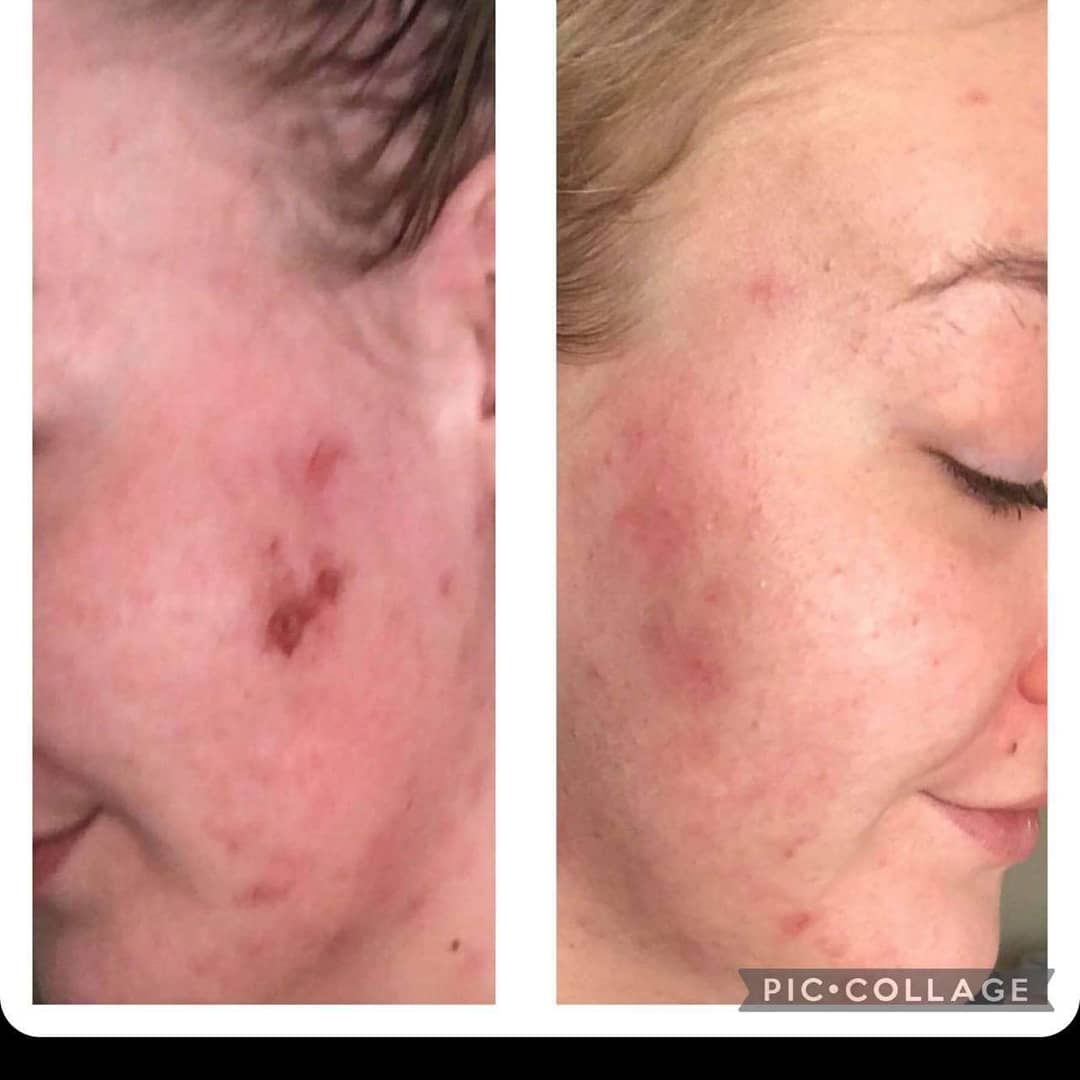 meduffield's tweet image. Friends, if you care about your skin, you have to check out this amazing skin care device!
7 benefits in just 2 minutes!
Works on a whole host of skin issues as well as fine lines and wrinkles and reduces the size of pores!
I highly recommend this device!