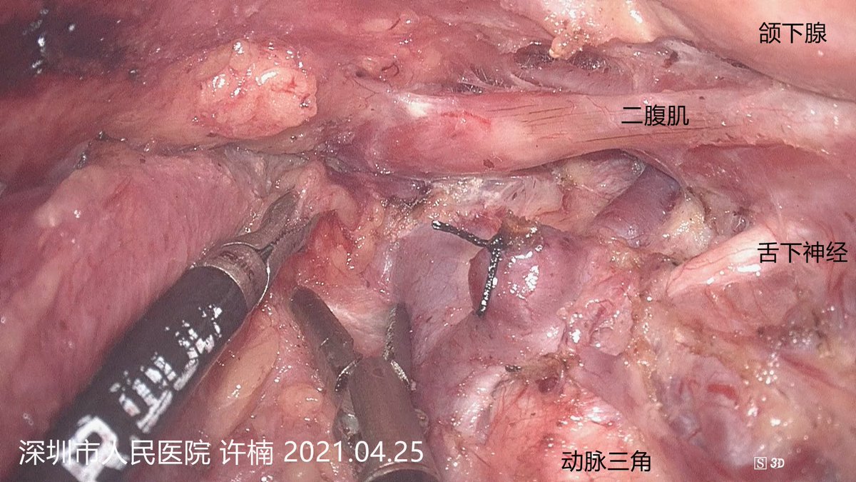 Total thyroidectomy and neck dissection via  chest wall approach in papillary carcinoma.